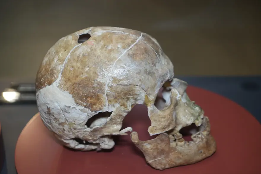 A 5,000-Year-Old Skull Reveals One of the Earliest Medical Interventions in Anatolia